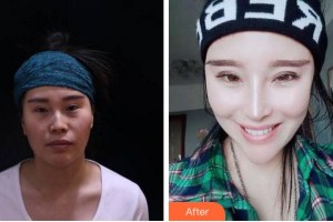 馬鞍山福華醫(yī)療美容醫(yī)院呂福華整形價(jià)格表附耳軟骨復(fù)合隆鼻案例展示