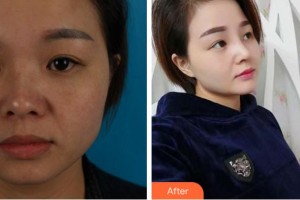 馬鞍山福華醫(yī)療美容醫(yī)院周曉晶整形價(jià)格表附耳軟骨復(fù)合隆鼻案例展示
