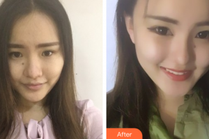 廣州現(xiàn)代醫(yī)院數(shù)字化整形美容中心謝大明整形價格表附鼻部手術(shù)案例展示