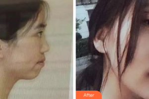 廣州中科美整形醫(yī)院陳昌華整形價格表附金屬托槽矯正案例展示