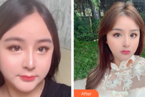 廣州天姿醫(yī)學(xué)美容門診部周祺整形價格表附面部吸脂案例展示