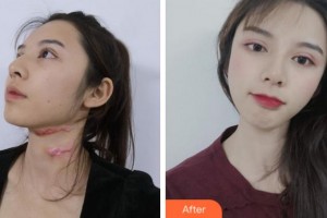 淮北時光整形美容醫(yī)院劉慧整形價格表附微創(chuàng)疤痕修復(fù)案例展示