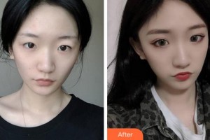 淮北市中醫(yī)院整形美容?？贫艜該P整形價格表附切開雙眼皮案例展示