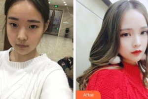淮北博愛口腔醫(yī)院李龍整形價格表附切開雙眼皮案例展示