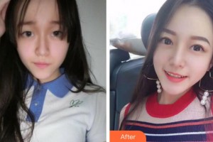 銅陵市立醫(yī)院眼科胡入虎整形價格表附切開雙眼皮案例展示