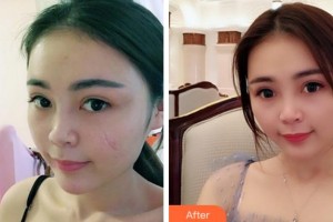 安慶石化醫(yī)院醫(yī)學美容中心丁應忠整形價格表附注射祛疤案例展示