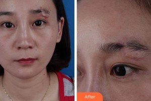 安慶亞星醫(yī)療美容門診部楊帆整形價格表附微創(chuàng)疤痕修復案例展示