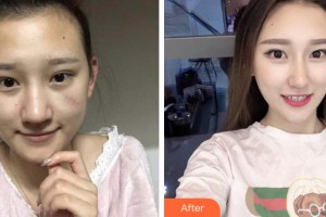 安慶維多利亞醫(yī)療美容門診部熊韜整形價格表附微創(chuàng)疤痕修復案例展示