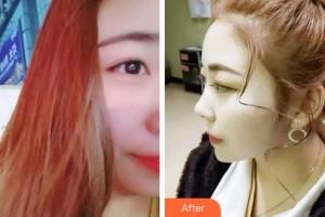安慶渡江口腔醫(yī)院朱根蘭整形價格表附超聲波潔牙案例展示