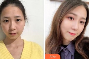 浙江省中醫(yī)院整形美容中心朱衛(wèi)菊整形價格表附超激光美膚案例展示