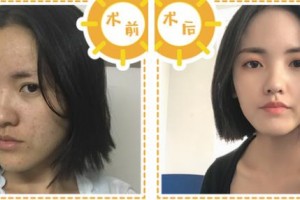 浙江省人民醫(yī)院整形外科張志民整形價格表附埋線提升案例展示
