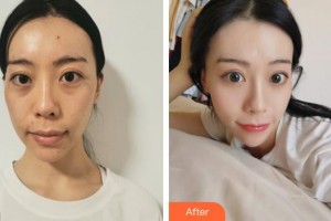 浙江衢化醫(yī)院激光整形美容中心劉利平整形價格表附埋線提升案例展示