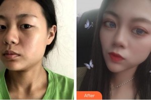 浙江省眼科醫(yī)院趙云娥整形價(jià)格表附眼部綜合案例展示