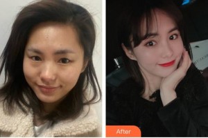 浙江省眼科醫(yī)院方愛(ài)武整形價(jià)格表附眼部整形案例展示