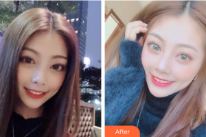 廣州雅度口腔門診部伍崇文整形價(jià)格表附牙齒美白案例展示