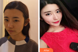 廣州星念醫(yī)療美容門診部陳春梅整形價(jià)格表附黑臉娃娃案例展示