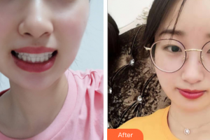 廣州穗華口腔醫(yī)院孔衛(wèi)東整形價格表附隱形矯正案例展示