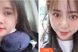 廣州穗華口腔醫(yī)院李欽濤整形價格表附自鎖托槽矯正案例展示