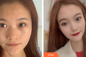 廣州姬妍醫(yī)療美容門診部龔湛整形價格表附鼻部手術案例展示