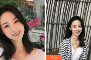 廣州愛康健口腔門診部辛萍整形價格表附自鎖托槽矯正案例展示