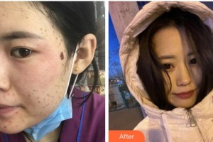 杭州時光醫(yī)療美容醫(yī)院劉耿整形價格表附激光美膚激光案例展示