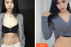 杭州華山連天美醫(yī)療美容整形醫(yī)院高俊明整形價格表附激光祛疤案例展示