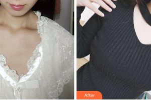 杭州華山連天美醫(yī)療美容整形醫(yī)院馮國松整形價格表附隆胸案例展示