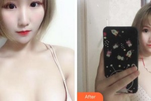 杭州時光醫(yī)療美容醫(yī)院呂敏整形價格表附自體脂肪隆胸案例展示