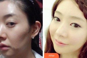 杭州新友好整形醫(yī)院袁利森整形價格表附埋線提升案例展示