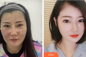 杭州東方整形外科門診部周慎健整形價格表附熱瑪吉案例展示