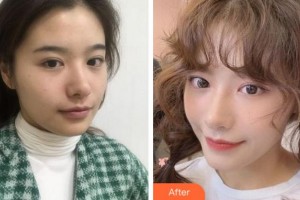 杭州維多利亞醫(yī)療美容醫(yī)院胡珊鶯整形價格表附熱瑪吉案例展示