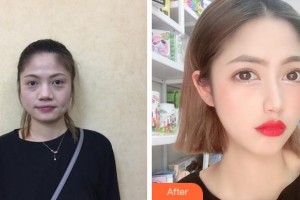 杭州愛琴海醫(yī)療美容醫(yī)院李華整形價格表附埋線提升案例展示