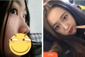 杭州整形醫(yī)院張占召整形價格表附肋軟骨隆鼻案例展示