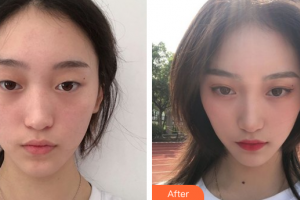 廣州美博匯醫(yī)療美容門診部李杰整形價(jià)格表附眼部手術(shù)案例展示