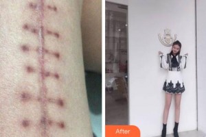 杭州蕭山區(qū)第一人民醫(yī)院整形燒傷科王定國整形價格表附微創(chuàng)疤痕修復(fù)案例展示