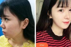 杭州星顏醫(yī)療美容診所高壽松整形價格表附鼻部綜合案例展示