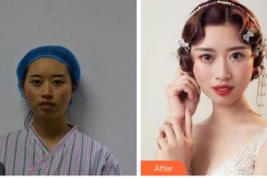 杭州顏術悅容醫(yī)療美容診所宋為民整形價格表附埋線提升案例展示
