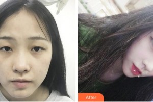 杭州珍美顏醫(yī)療美容診所沈明強(qiáng)整形價(jià)格表附切開雙眼皮案例展示