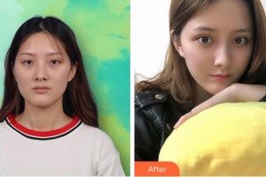 杭州昕微整形美容醫(yī)院漆淳整形價(jià)格表附內(nèi)切祛眼袋案例展示