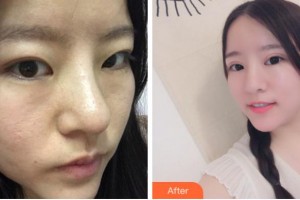 杭州格萊美整形美容醫(yī)院張霞飛整形價(jià)格表附切開雙眼皮案例展示