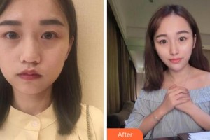 杭州麗星醫(yī)療美容診所薛少真整形價(jià)格表附熱瑪吉案例展示