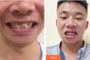 義烏杭州口腔門(mén)診部朱保民整形價(jià)格表附牙齒隱形矯正案例展示