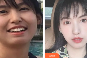 惠州白天鵝口腔醫(yī)院陳士秀整形價格表附牙齒矯正案例展示