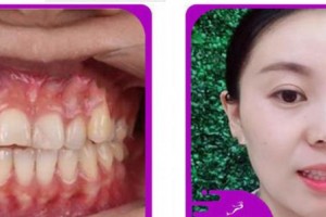 杭州良渚口腔門診部方豪整形價格表附牙齒隱形矯正案例展示