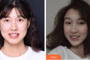 杭州博凡口腔門診部鄭春穎整形價格表附牙齒隱形矯正案例展示