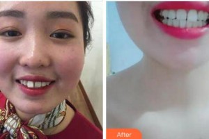 杭州國雅口腔醫(yī)院萬成鋒整形價(jià)格表附牙齒隱形矯正案例展示