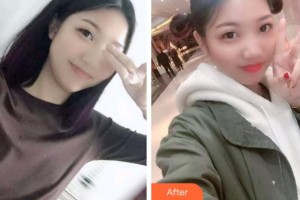 杭州國雅口腔醫(yī)院張虹整形價(jià)格表附根管調(diào)節(jié)案例展示