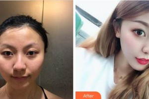 杭州太學(xué)眼科門診部邱培瑾整形價(jià)格表附上眼瞼去脂案例展示