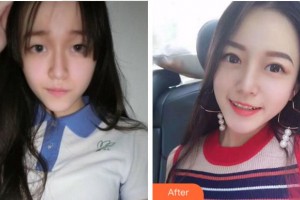 杭州口腔醫(yī)院劉敏整形價(jià)格表附切開雙眼皮案例展示