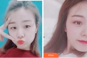 杭州西湖之江眼科醫(yī)院趙向陽整形價(jià)格表附眼部綜合案例展示